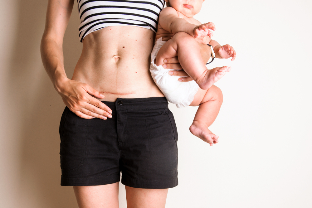Women born via cesarean delivery can have Obesity and Type 2 diabetes in adulthood