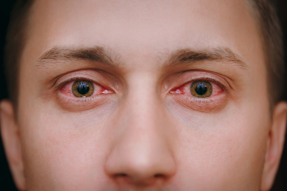 Tips for Glaucoma Patients during COVID-19