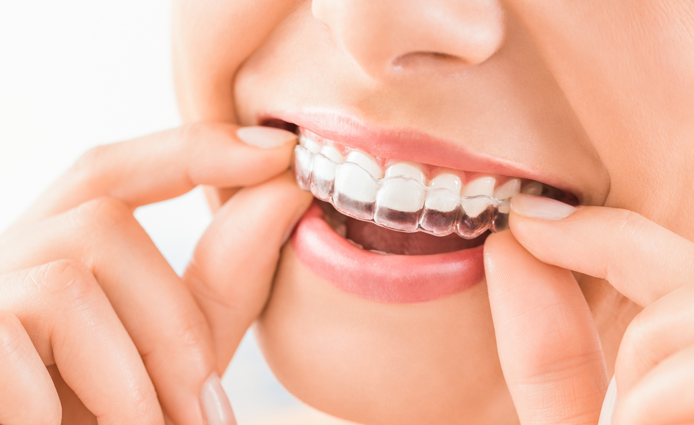 Transform your smile with Invisible Braces