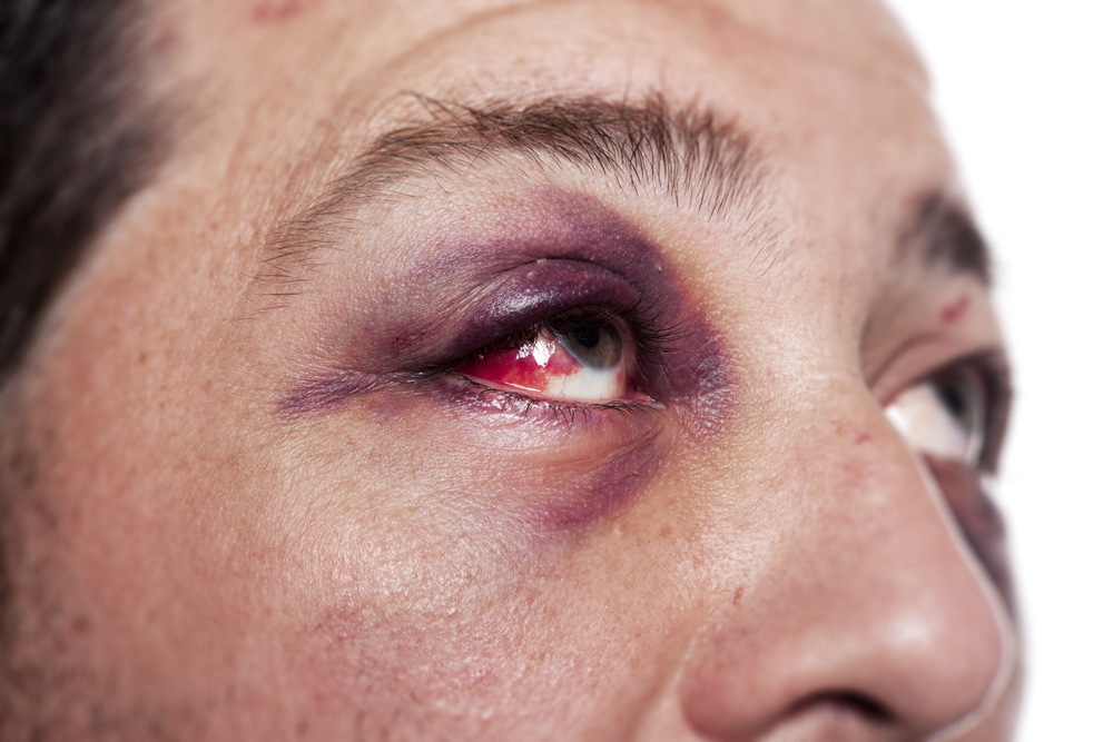 How patients are suffering from Ocular trauma during COVID-19