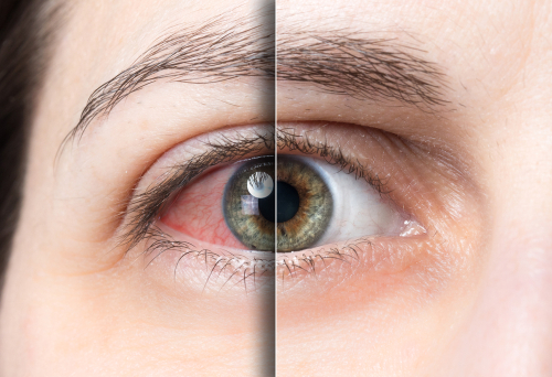 Age-related macular degeneration and how it affects old people