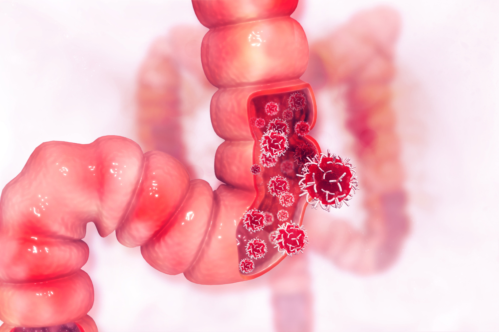 Increased risk of colon cancer in younger people has grown in recent years