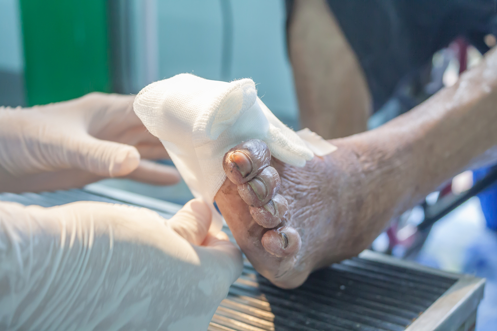 How to prevent and care for Diabetic Foot Ulcers and Pain?