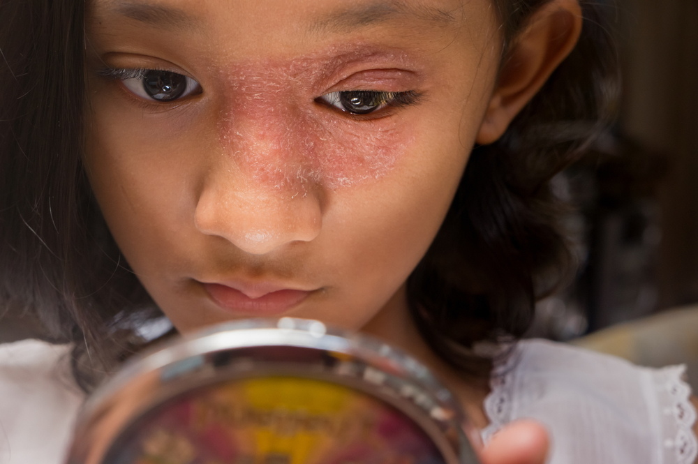 Treatments for Atopic Dermatitis and Eczema in Children