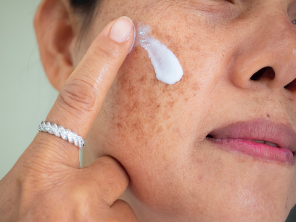 Unmasking the causes and treatments of melasma