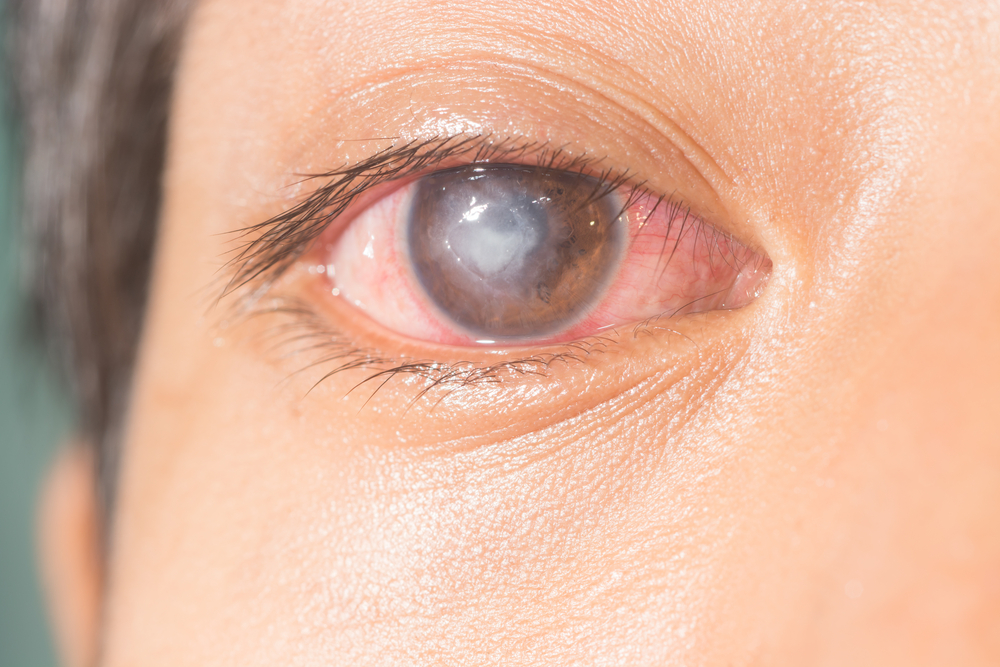 Fungal keratitis eye infection blinds over half a million in one eye