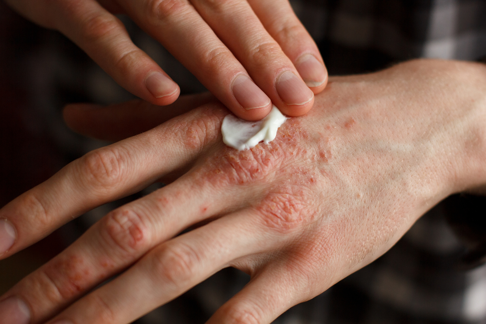 Which Psoriasis Treatments During Pregnancy are safe?